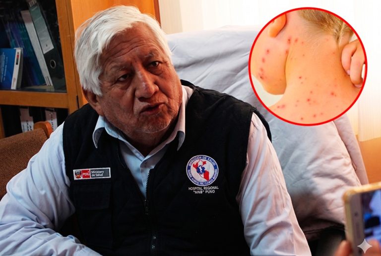 PUNO: AUMENTAN CASOS DE SARAMPIÓN EN JÓVENES Y ADULTOS NO VACUNADOS, ALERTA EPIDEMIÓLOGO PERCY CASAPERALTA